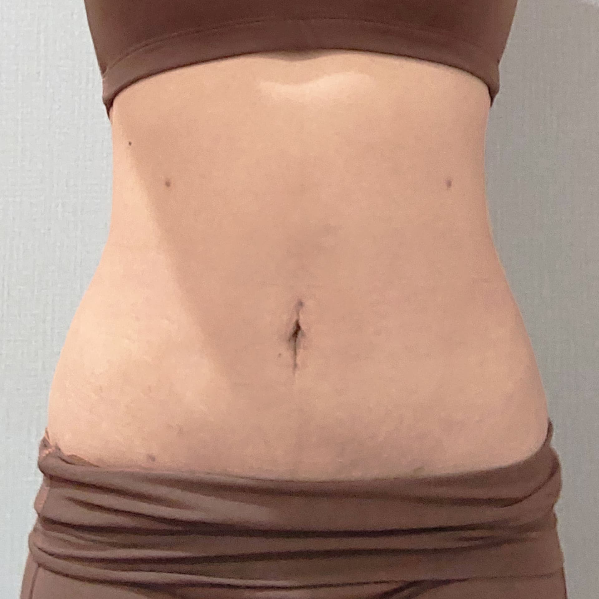 3 month after LAMS