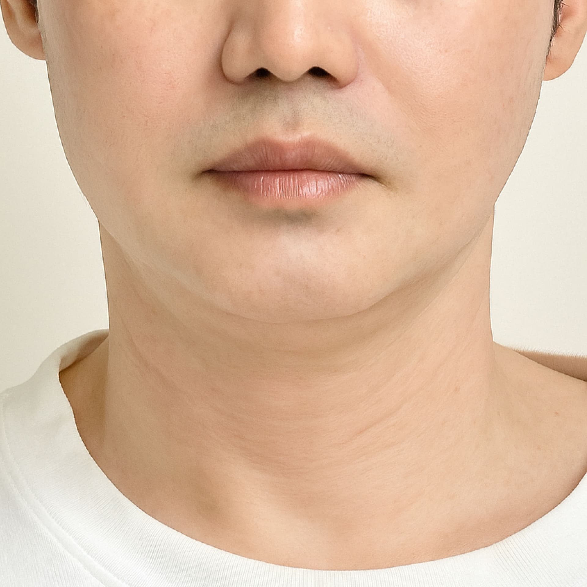 8 months after double chin LAMS