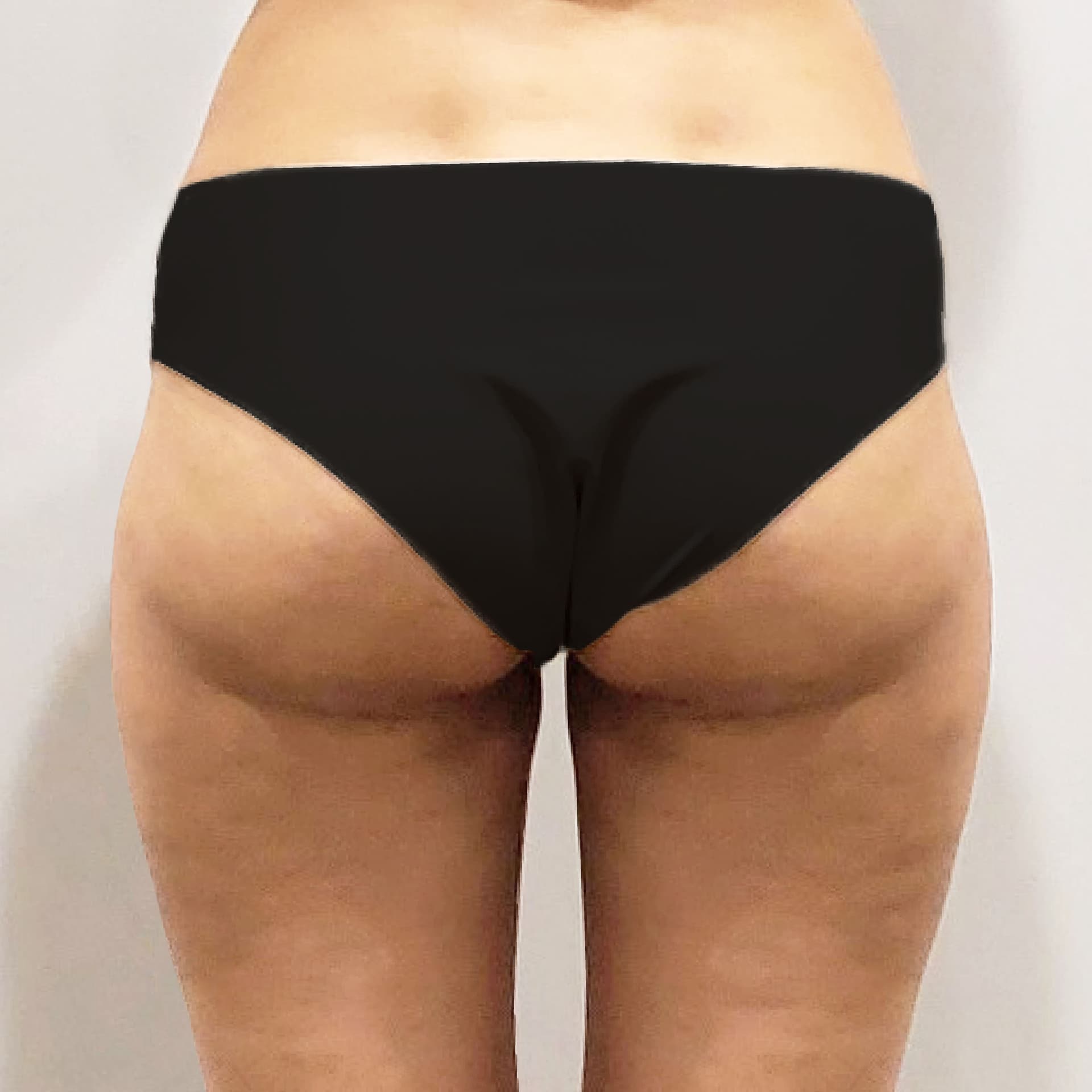 3 Months After Hip Up LAMS