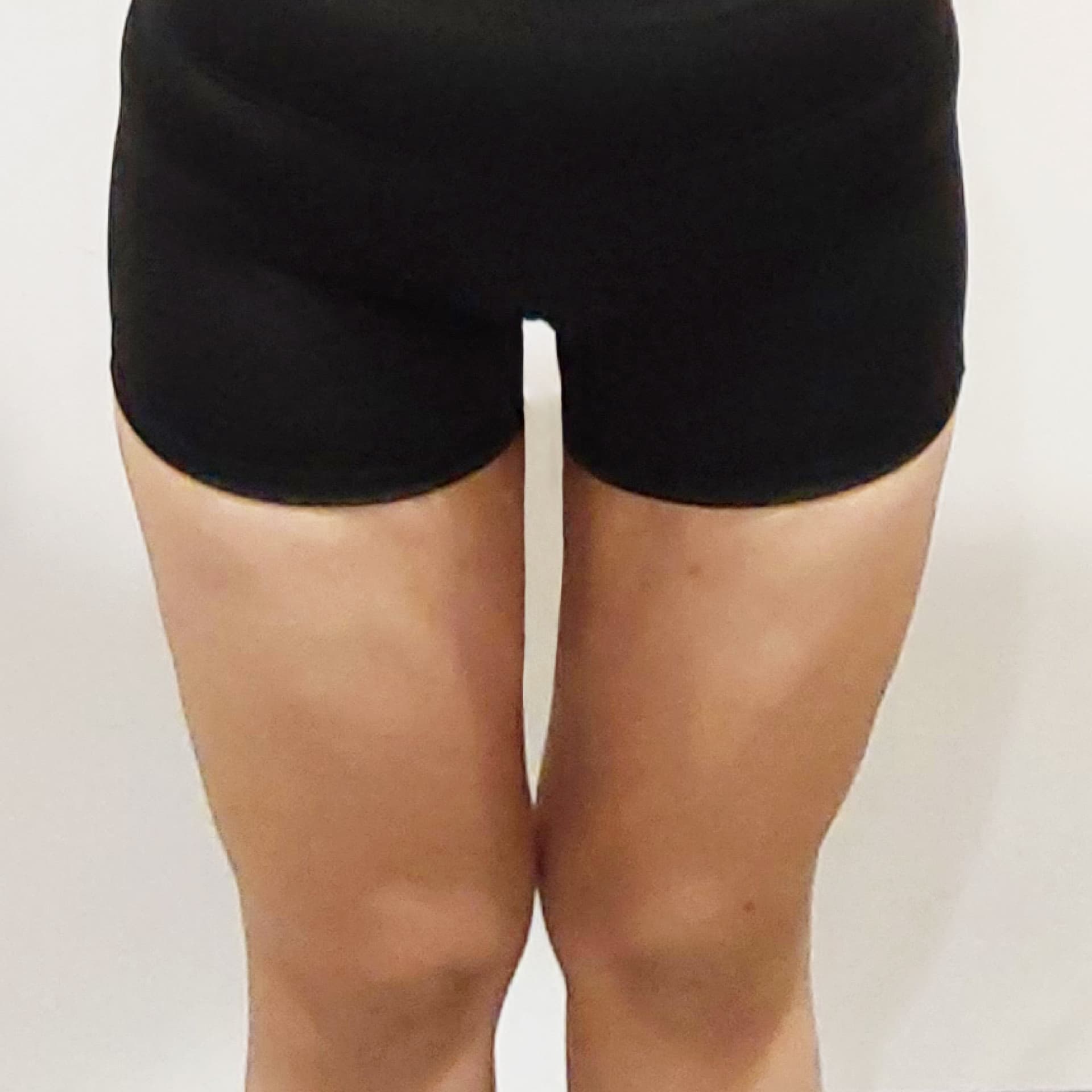 3 Months After Thighs LAMS