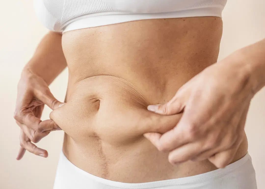 Cryolipolysis vs. Liposuction: What's the Difference?